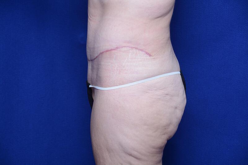 Abdominoplasty Gallery Before & After Image