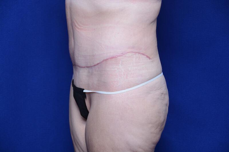 Abdominoplasty Gallery Before & After Image