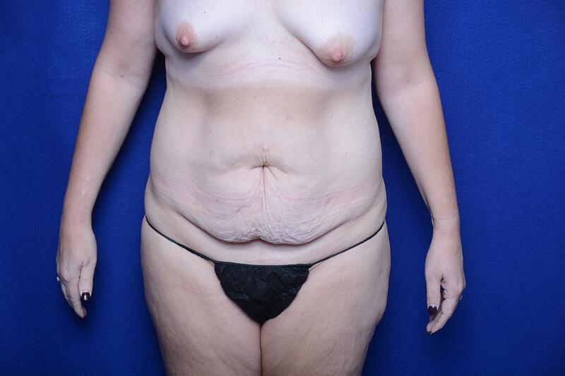 Abdominoplasty Gallery Before & After Image