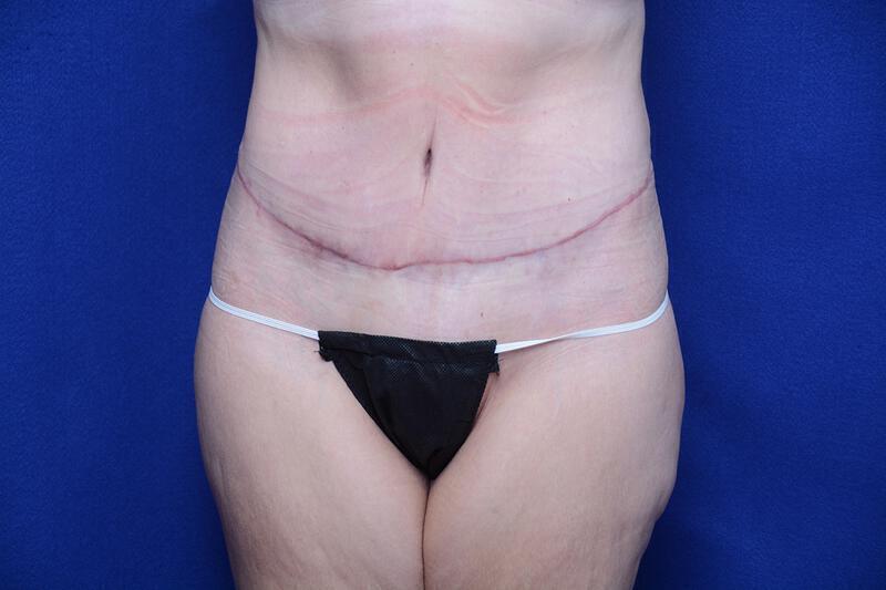 Abdominoplasty Gallery Before & After Image