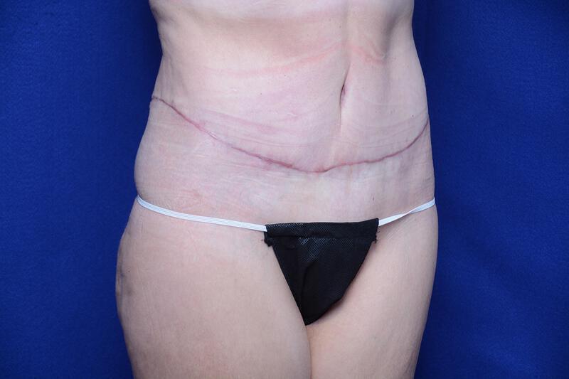 Abdominoplasty Gallery Before & After Image