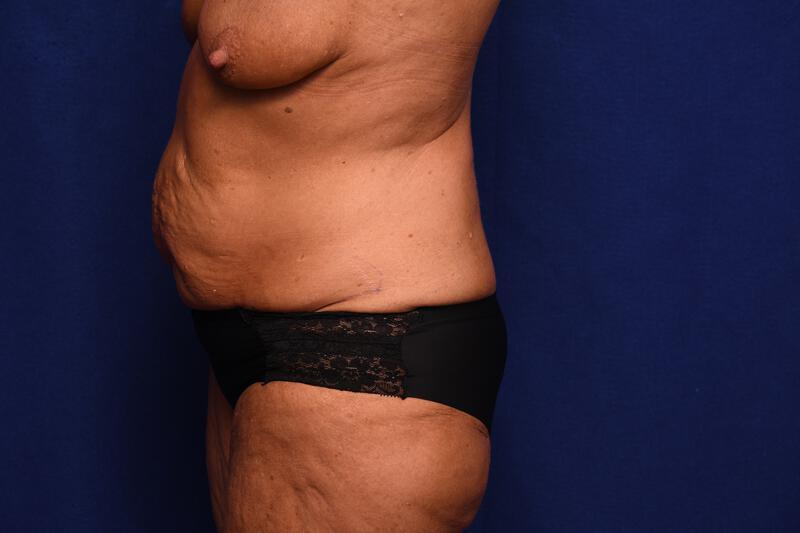 Abdominoplasty Gallery Before & After Image