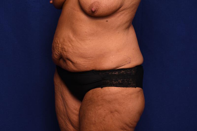 Abdominoplasty Gallery Before & After Image