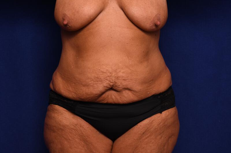 Abdominoplasty Gallery Before & After Image