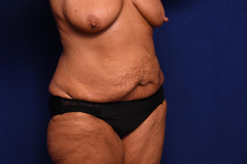 Abdominoplasty Gallery Before & After Image