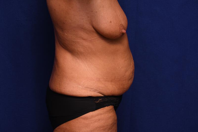 Abdominoplasty Gallery Before & After Image