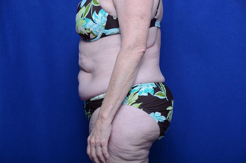 Abdominoplasty Gallery Before & After Image