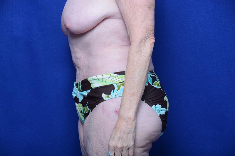 Abdominoplasty Gallery Before & After Image