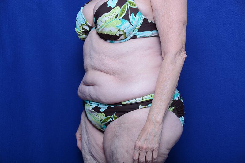 Abdominoplasty Gallery Before & After Image