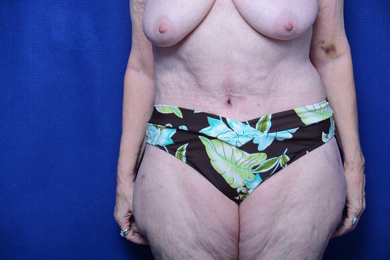 Abdominoplasty Gallery Before & After Image