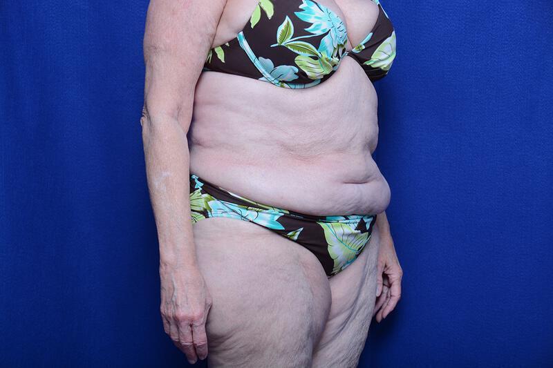 Abdominoplasty Gallery Before & After Image