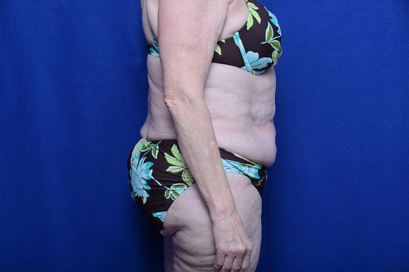 Abdominoplasty Gallery Before & After Image