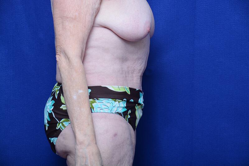 Abdominoplasty Gallery Before & After Image