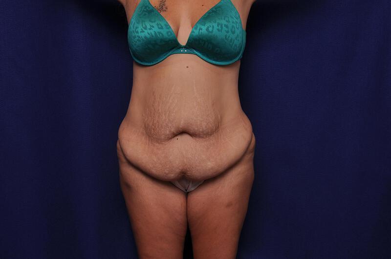 Abdominoplasty Gallery Before & After Image