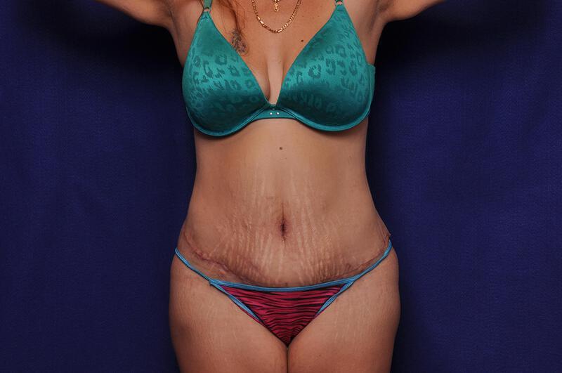 Abdominoplasty Gallery Before & After Image