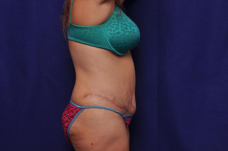 Abdominoplasty Gallery Before & After Image