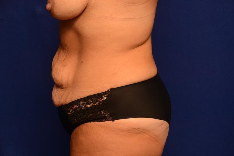 Abdominoplasty Gallery Before & After Image