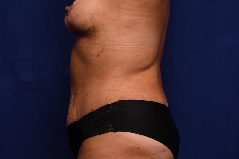 Abdominoplasty Gallery Before & After Image