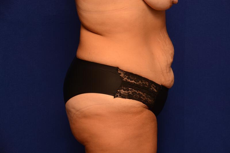 Abdominoplasty Gallery Before & After Image