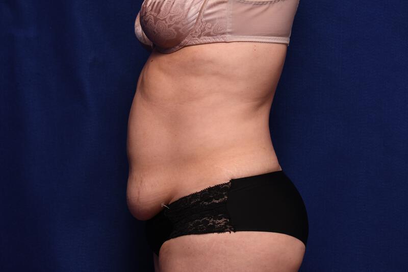 Abdominoplasty Gallery Before & After Image