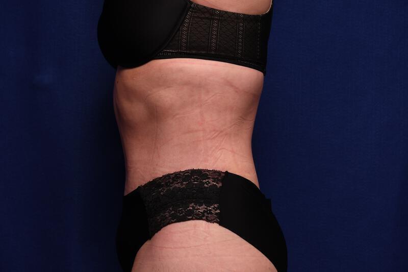 Abdominoplasty Gallery Before & After Image