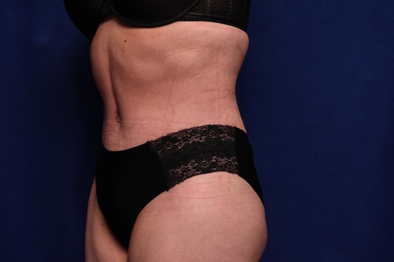 Abdominoplasty Gallery Before & After Image