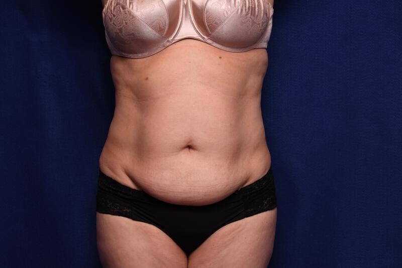 Abdominoplasty Gallery Before & After Image