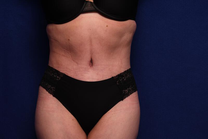 Abdominoplasty Gallery Before & After Image