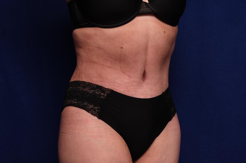 Abdominoplasty Gallery Before & After Image