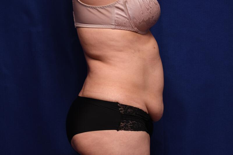 Abdominoplasty Gallery Before & After Image