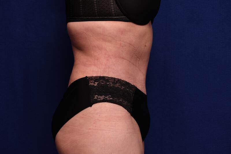 Abdominoplasty Gallery Before & After Image