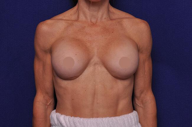 Athletic Breast Augmentation Revision Gallery Before & After Image