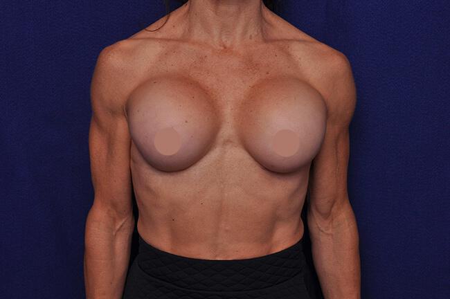 Athletic Breast Augmentation Revision Gallery Before & After Image