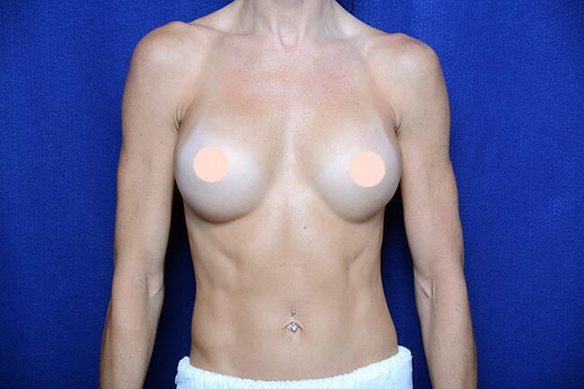 Athletic Breast Augmentation Revision Gallery Before & After Image