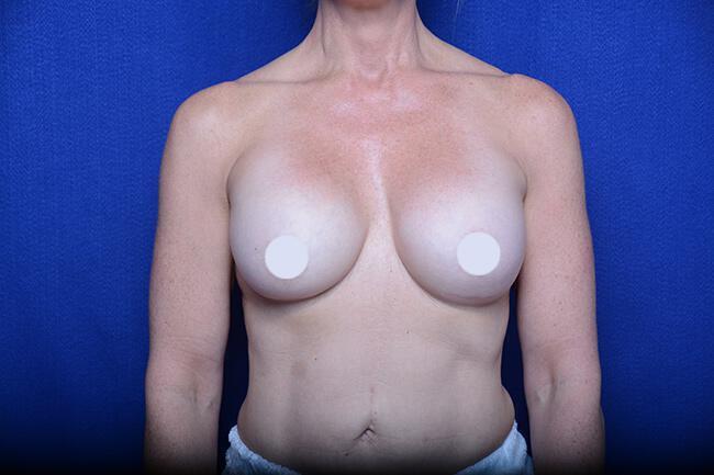 Athletic Breast Augmentation Revision Gallery Before & After Image