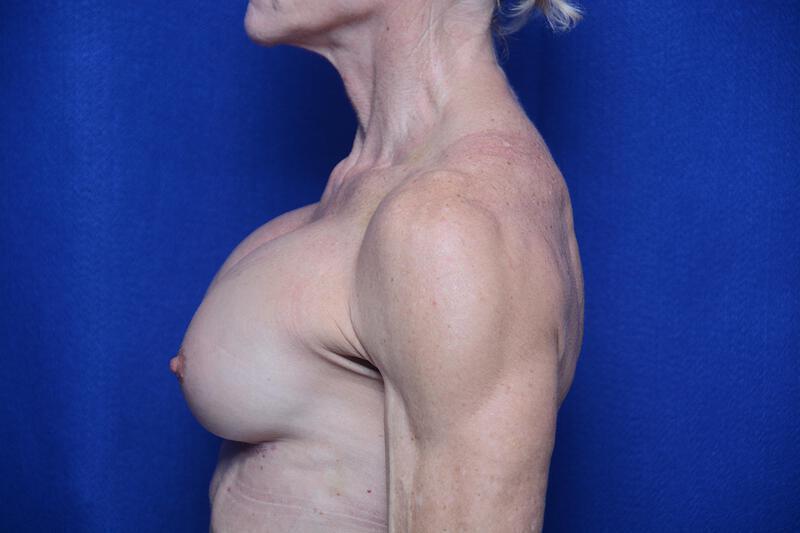 Athletic Breast Augmentation Revision Gallery Before & After Image