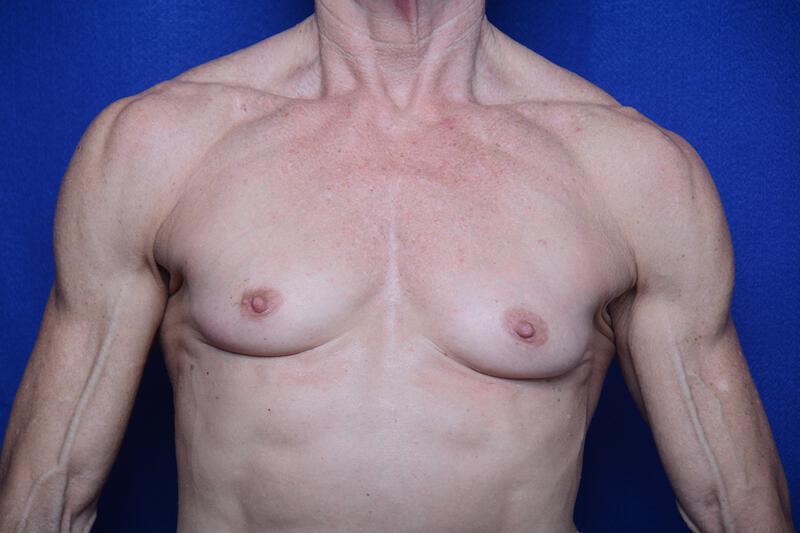 Athletic Breast Augmentation Revision Gallery Before & After Image