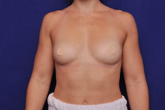 Athletic Breast Augmentation Gallery Before & After Image