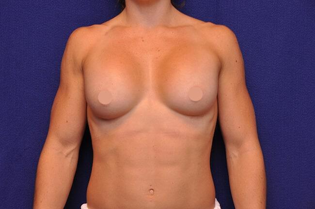 Athletic Breast Augmentation Gallery Before & After Image