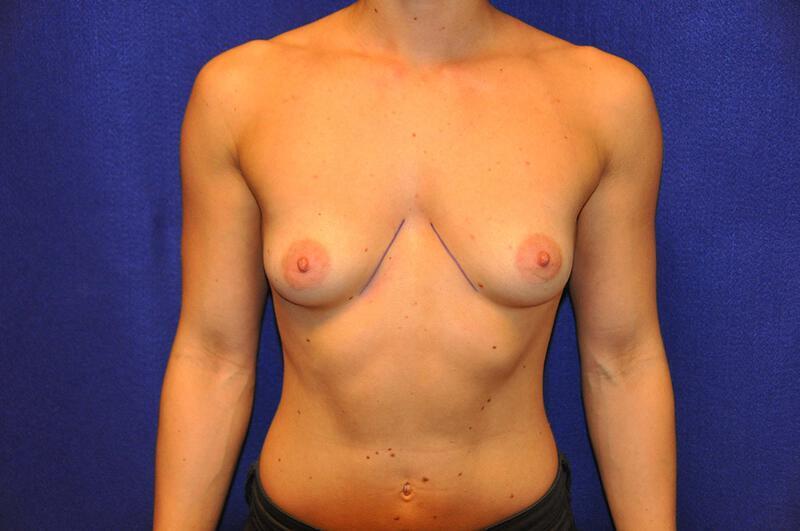 Athletic Breast Augmentation Gallery Before & After Image