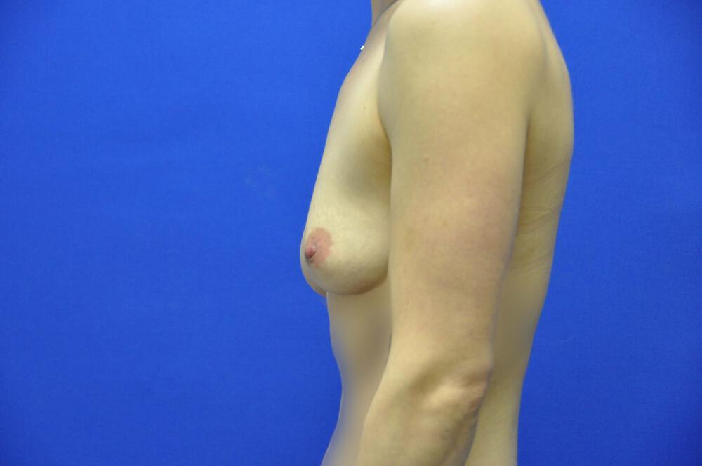 Athletic Breast Augmentation Gallery Before & After Image