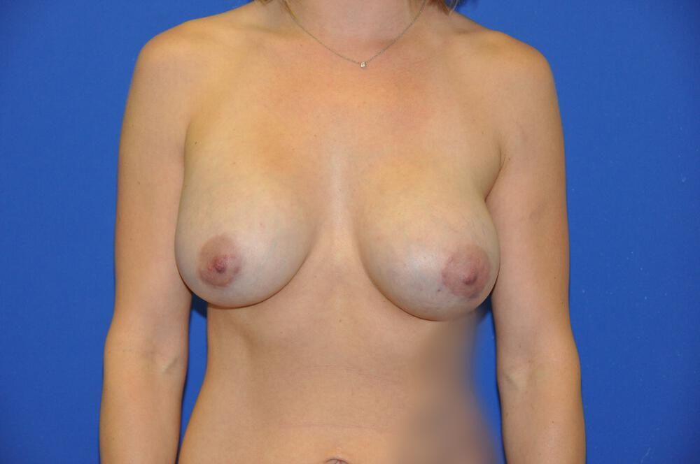 Athletic Breast Augmentation Gallery Before & After Image