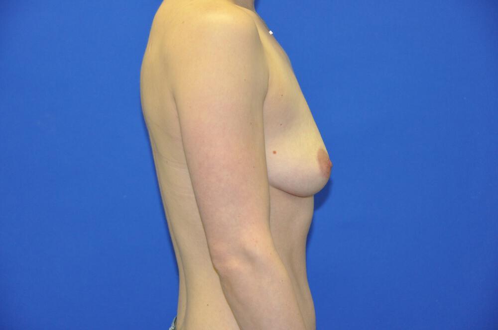 Athletic Breast Augmentation Gallery Before & After Image