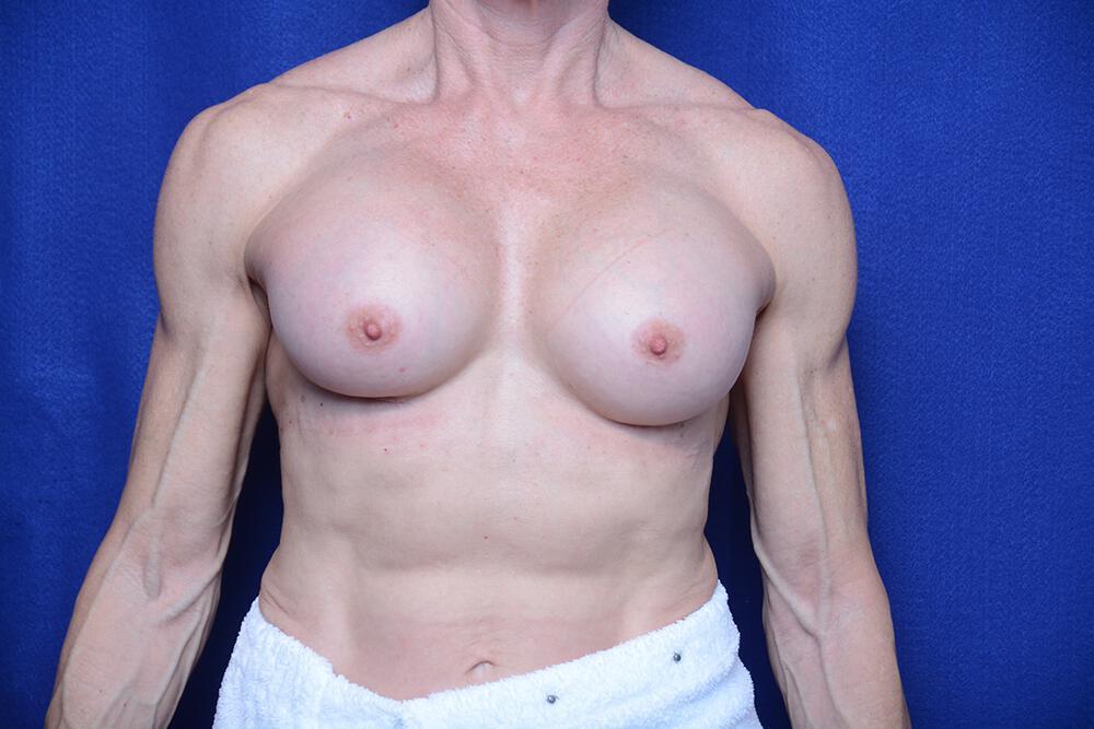 Athletic Breast Augmentation Gallery Before & After Image