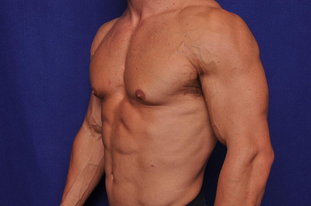 Bodybuilder Gynecomastia Gallery Before & After Image