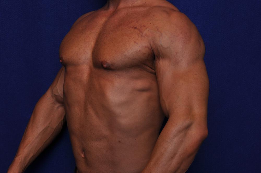 Bodybuilder Gynecomastia Gallery Before & After Image