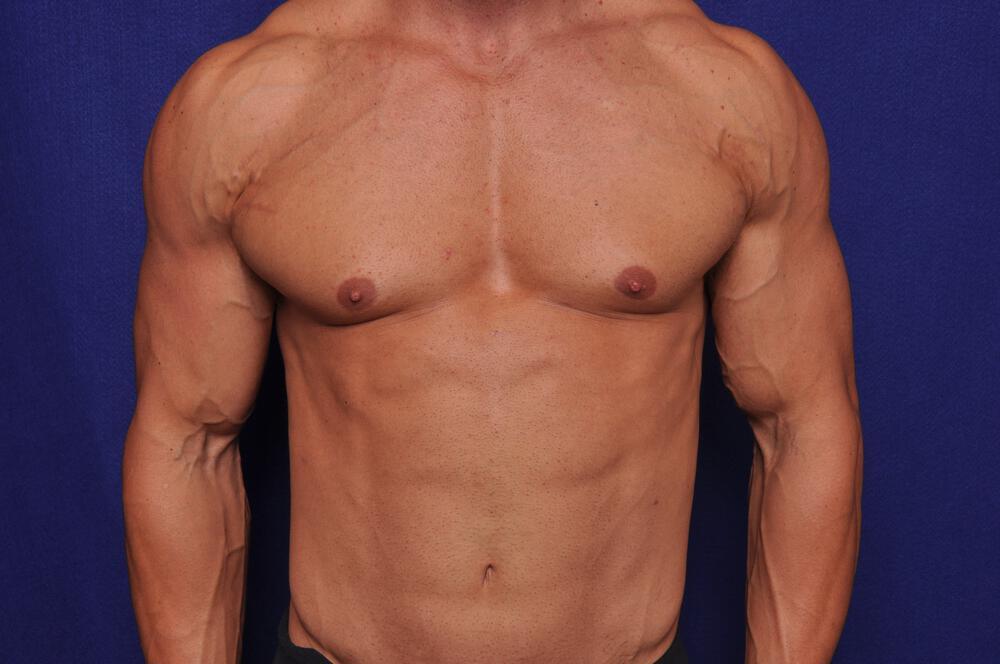 Bodybuilder Gynecomastia Gallery Before & After Image