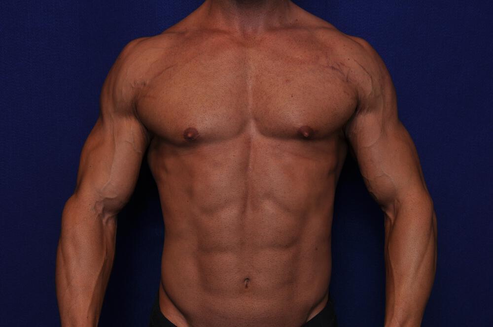 Bodybuilder Gynecomastia Gallery Before & After Image