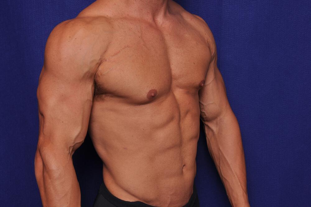 Bodybuilder Gynecomastia Gallery Before & After Image