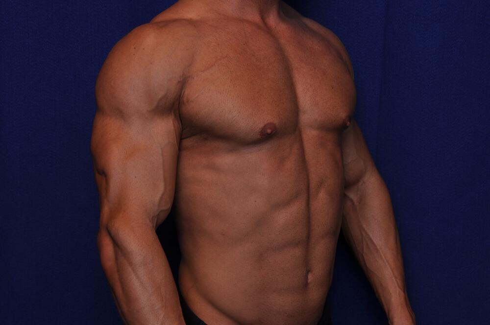 Bodybuilder Gynecomastia Gallery Before & After Image